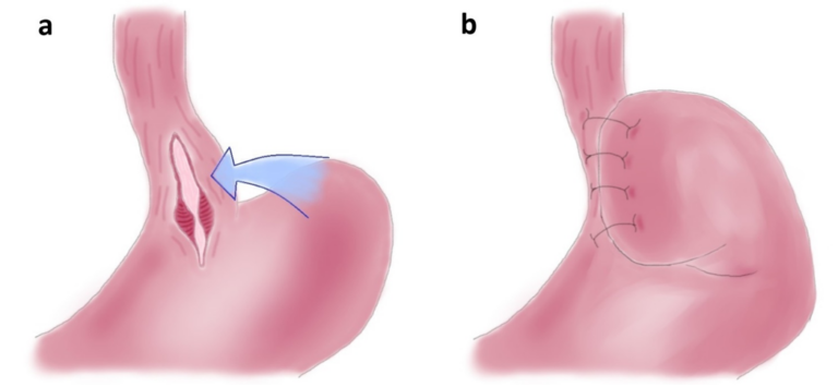icors acalasia esofagea