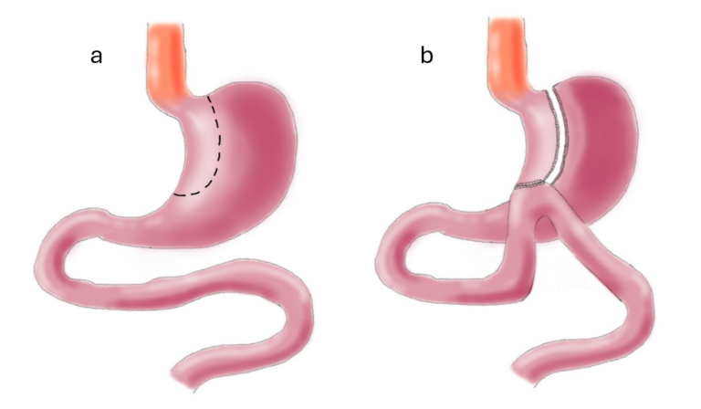 icors bypass gastrico singolo