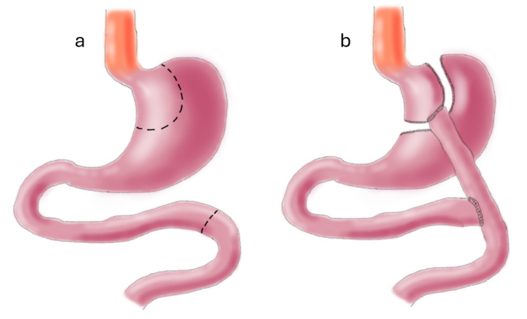 icors anamostosi doppia bypass gastrico