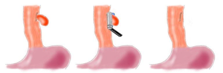icors diverticoli esofagei intratoracici