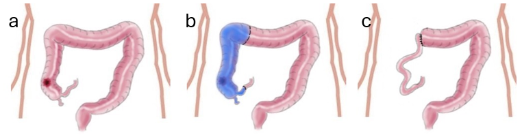 icors emicolectomia destra