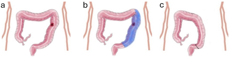 emicolectomia sinistra tumore colon icors