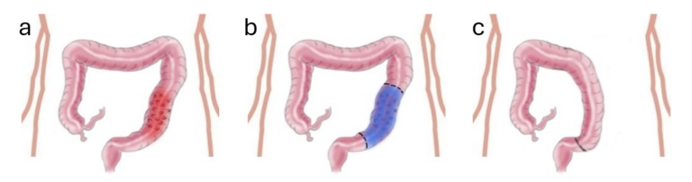 icors diverticolare colon rettale