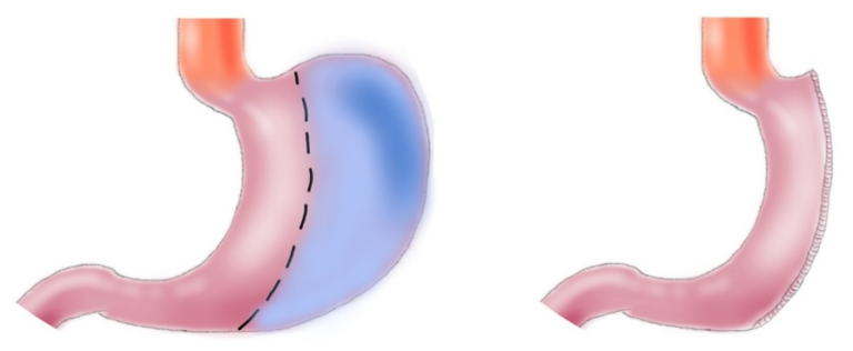 icors sleeve gastrectomy