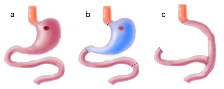 icors tumore maligno gastrico