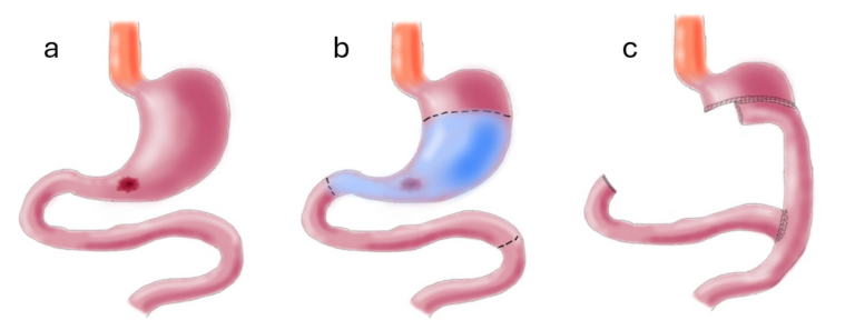 icors tumore maligno gastrico